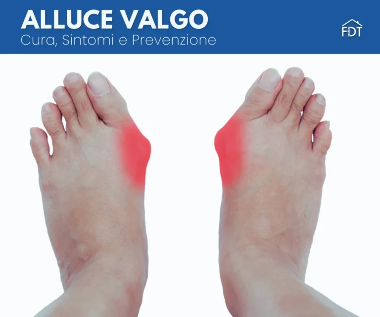 Alluce Valgo: cause, sintomi, cura e prevenzione