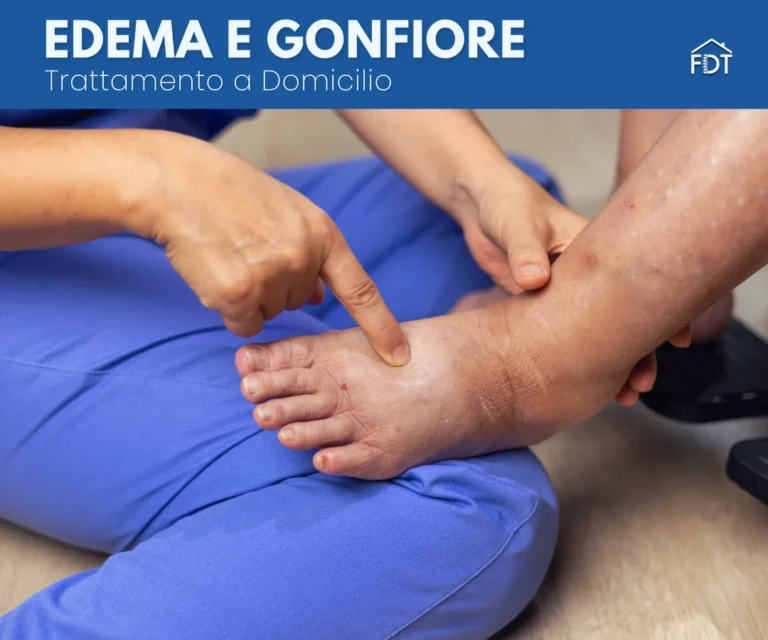 Edema: Cause, Sintomi e Fisioterapia a Domicilio – Edema Periferico e Segno della Fovea