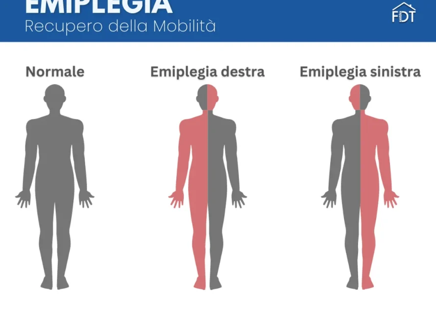 Silhouette corpo umano con evidenziata in rosso la parte colpita da emiplegia destra e sinistra