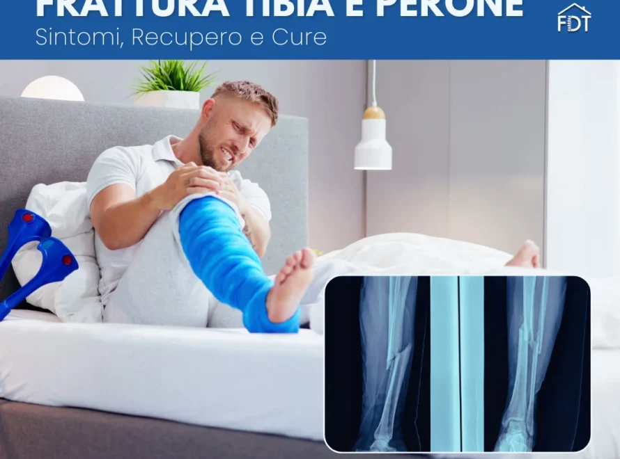 Uomo con gesso gamba e radiografia frattura tibia perone