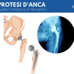 Radiografia e illustrazione anatomica di una protesi d'anca inserita