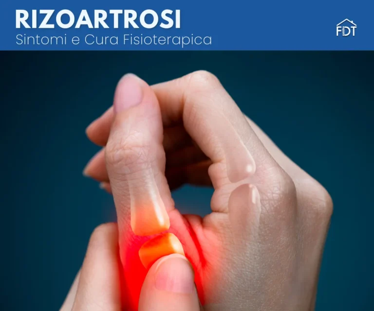 Rizoartrosi Pollice: sintomi, cause e cura fisioterapica
