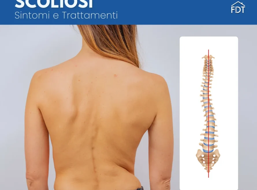 Schiena femminile nuda con linea rossa che indica la curvatura della colonna per scoliosi