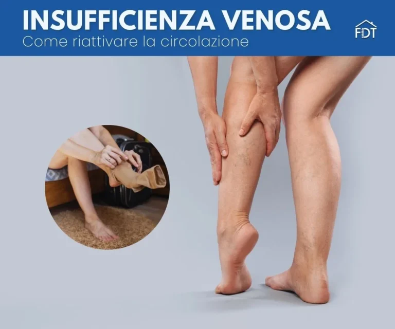 Insufficienza Venosa e Gambe Gonfie: Cause, Sintomi e i Rimedi Fisioterapici