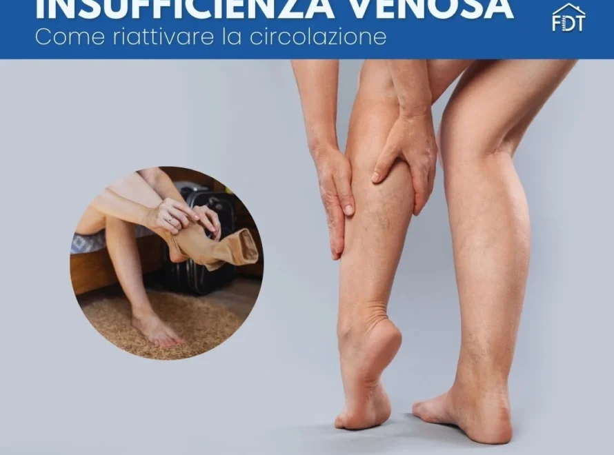 Primo piano di gambe con vene varicose e inserto di una persona che indossa una calza a compressione graduata.