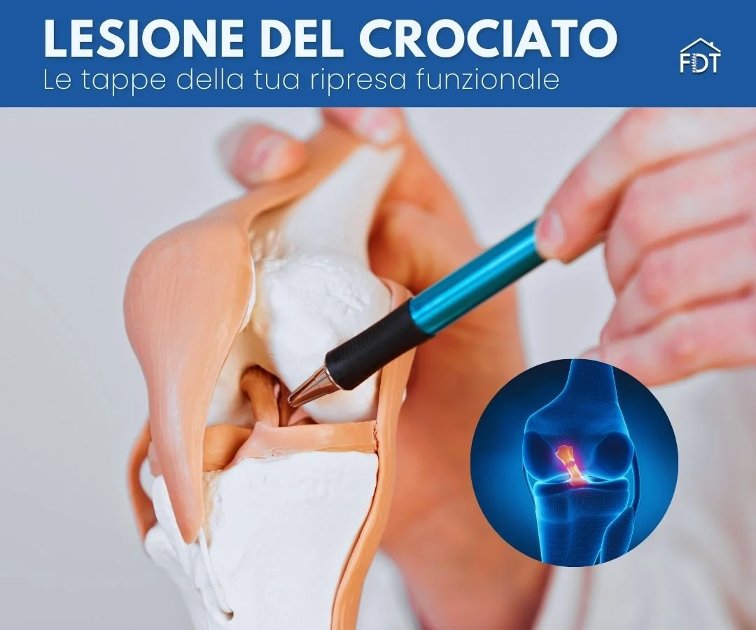 Modello anatomico di ginocchio con indicazione della lesione del legamento crociato anteriore e inserto grafico 3D.